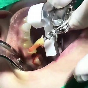 #Odontología. Un simple y eficaz método de extracción dental. -Benex Extraction System. | Sinergia virtual