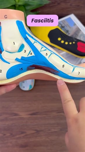 For anyone with high arches struggling with foot pain after long...