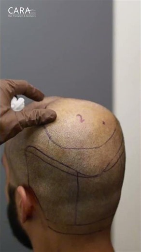 Precision Hair Mapping: The First Step to Hair Restoration