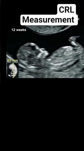 How to measure crown rump length correctly on ultrasound? #ultrasound