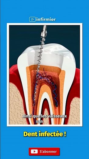 Comment un dentiste soigne une infection dentaire #santébuccodentaire #shorts