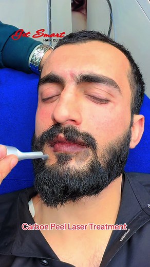 Understanding Carbon Peel Laser Treatment Benefits