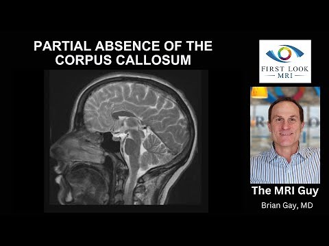 Partial absence of the corpus callosum