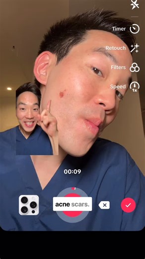 Dr. David Kim on Instagram: "How I got rid of my acne scar! I had a bad pimple on my cheek earlier this year (yes, even derms get pimples) and this is how I treated it. When you’re having an acne flare do less and simplify your routine! Doing more actives can irritate and inflame your skin 🤗 ✅ Cleanser - I used a cleanser from @cetaphil w/ salicylic acid, mandelic acid, PHA to gently cleanse and unclog my pores without irritating the skin ✅ Brightening serum - use a lightweight brightening seru