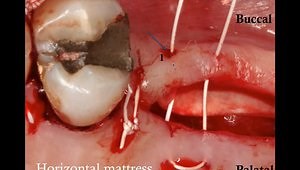 How to suture a large flap (a SurgicalMaster Instant Replay)