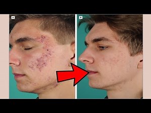 Acne Conglobata || What treatment options are available?
