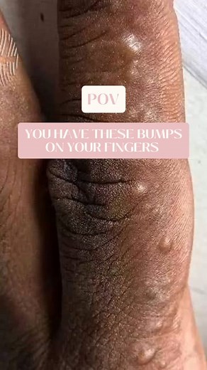 Do you have these? 😳🥺 If you did not know, this type of eczema is called Dyshidrotic Eczema and it's a skin condition that causes tiny, intensely itchy blisters on the hands or feet. It commonly presents in hot summer months. Treatment options… 👉🏽 Like any form of eczema, there is no cure 👉🏽 Identify and avoid triggers like strong detergents, sanitisers etc 👉🏽 Use fragrance free cleansers and moisturizers at all times. 👉🏽 Use treatment at the first sign of eruption 👉🏽 Neurotoxin inje