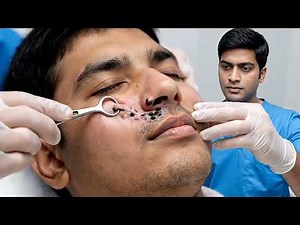 Extreme Blackhead Removal on Nose | Deep Pore Cleaning Facial | Blackhead