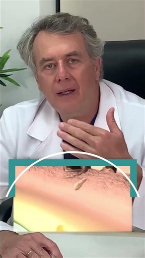 Blefaritis por Demodex #shorts