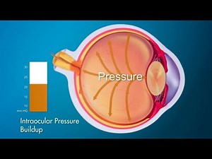 The mechanisms of optic nerve damage
