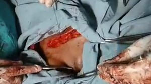 mons venus lift/:enhancement