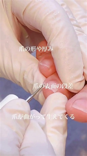 Nurse Foot Care｜Useful Toenail and Ingrown Toenail Care Techniques for Medical Settings #shorts
