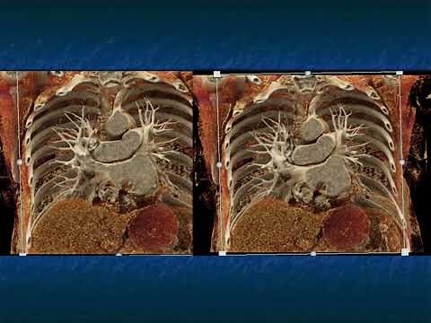 CT Detection and Evaluation of Cardiac Masses: What You Need to Know - Part 1