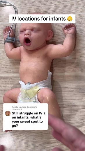 IV Locations for Infants - Best Practices and Techniques