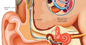 How The Deaf Community Is Dealing With Cochlear Implants
