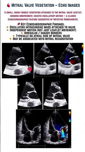 Mitral Valve Vegetation – Echo Images #MitralValve #Vegetation #InfectiveEndocarditis
