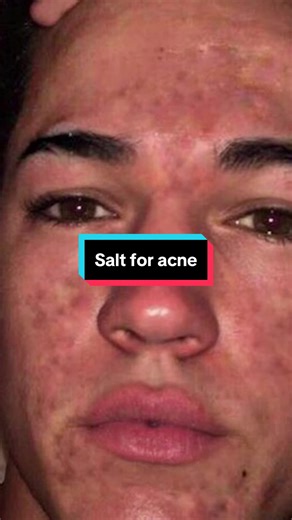 Reduce Acne Instantly with Fish Oil & Vitamin C Serum