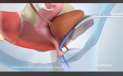 tension-free vaginal tape（TVT）经阴道无张力中段尿道吊带术