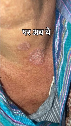 Fungal infection | Daad | दाद #shorts #tinea #skincare