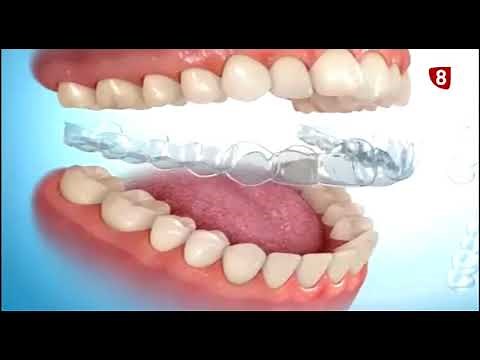 Ortodoncia Transparente - Alineadores Transparentes