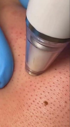 You Won't BELIEVE What Came Out! The Most Satisfying Deep Pore Cleanse EVER!