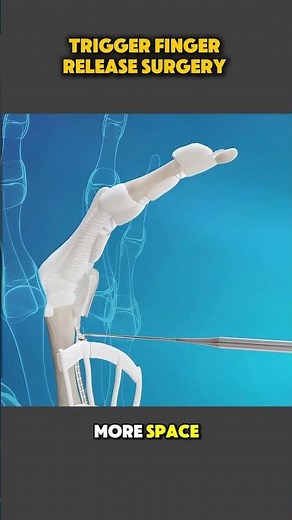 Trigger Finger Release Surgery – Step-by-Step Surgical Procedure Explained #triggerfinger