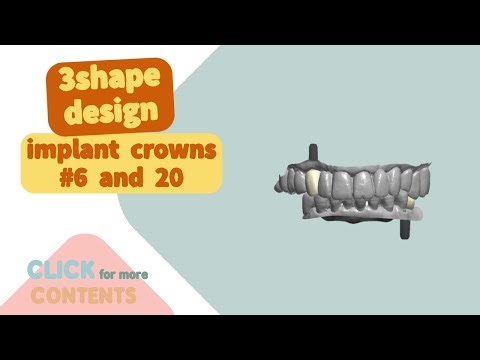 3shape design implant crowns #6 and 20