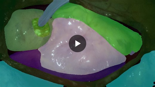 #computervision #gps #cardiacsurgeons #mitral #autonomous #robotics #physicalai #llm #vlm #cardiacsurgery | Jacques Kpodonu MD,FACC