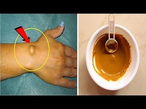 How to get rid of Lipoma - Lipoma treatment naturally permanently