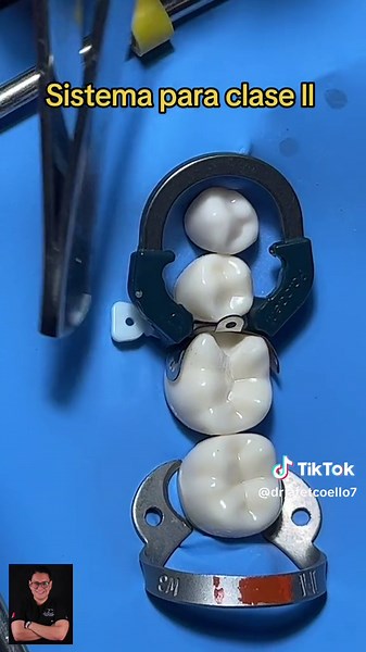 Restauración Clase II: Sistema de Matrices y Restauración Dental