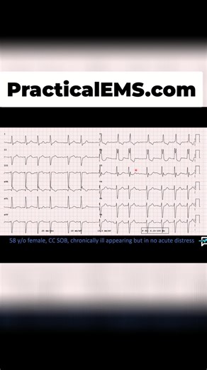 Decoding the EKG! Turns out, it's a right bundle branch block pattern. Who knew? #EKG #MedicalSchool #NurseLife #MedTok