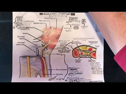 Ulnar Tunnel Syndrome (Guyon’s Canal Ulnar Nerve Compression / Entrapment)