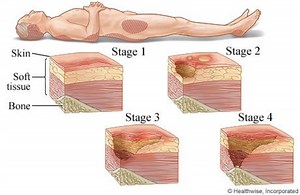 Pressure Ulcers: Cause
