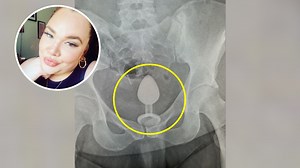 X-ray shows butt plug stuck inside ‘mortified’ woman