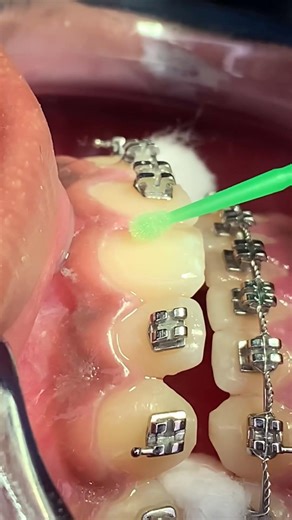 🔥Complete Process for Installing Metal Orthodontic Brackets🔥
