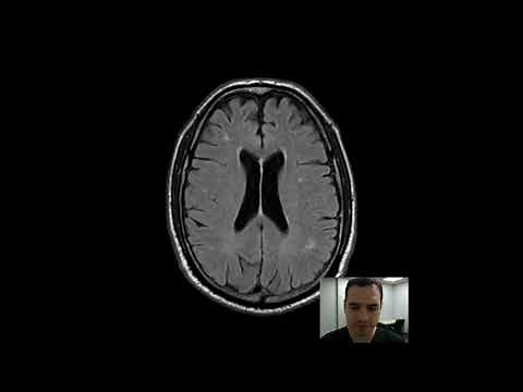 MRI BASICS - Secuencia FLAIR