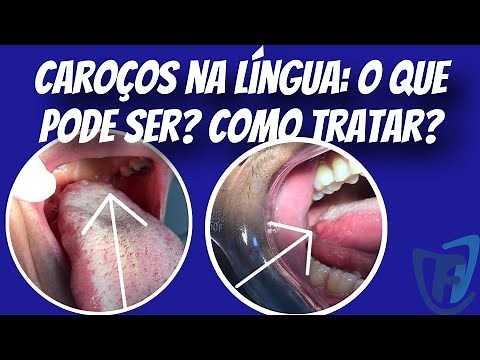 Caroço na língua: O que pode ser? Como Tratar? #estomatologia #línguas #drfranciscodeassisjr