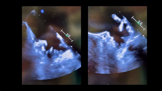 #laac | Boston Scientific Cardiology