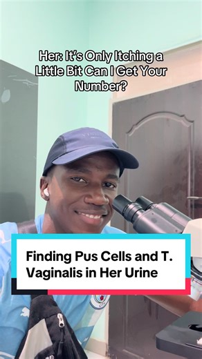 The presence of pus cells and Trichomonas vaginalis in urine usually indicates a urinary or genital tract infection. Pus cells (white blood cells) show that the body is responding to inflammation or infection, commonly due to bacteria or sexually transmitted organisms. Trichomonas vaginalis is a protozoan parasite that causes trichomoniasis, a sexually transmitted infection that can affect the urethra and genital tract, leading to symptoms such as burning during urination, abnormal discharge, it