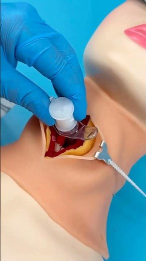 Tracheostomy