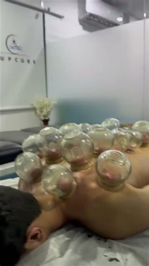 Fire Cupping Benefits: primarily centered on pain relief, muscle relaxation, improved blood flow.