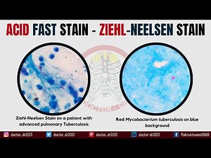 Acid Fast Stain Technique | Ziehl-Neelsen Stain | Microbiology Laboratory Techniques