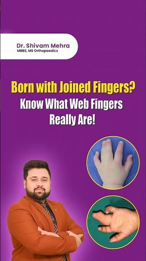 Born With Joined Fingers? Doctor Explains What Web Fingers Really Are!