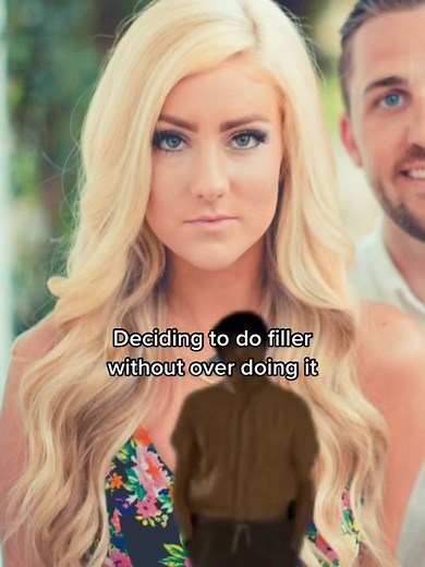 Transforming my Look with Lip Filler | Before and After Results