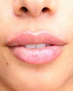 Look how beautiful these lippies look immediately after her lip augmentation with 1 syringe of Juvederm Ultra Plus XC! The first picture you see is her immediately post!! ————————————————— Using our rapid recovery technique helps minimize swelling and bruising! Ask your CC injector today about this technique 💉✨💯❤️💋 #californiacosmetics #lips #lippies #lipinjections #lipfiller #lipfillers #lipaugmentation #perfectlips #plumplips #lipgoals #injectables | California Cosmetics