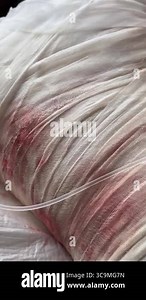 Severely burned body wrapped in medical gauze dressing, Close-up shows bloody bandages and healing process. Image highlights trauma care and emergency wound treatment after injury.