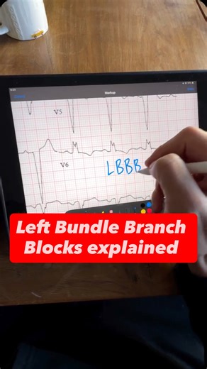 ECG Lectures with Reid on Instagram: "Short explanation of LBBB on ECG #ecg #ekg"
