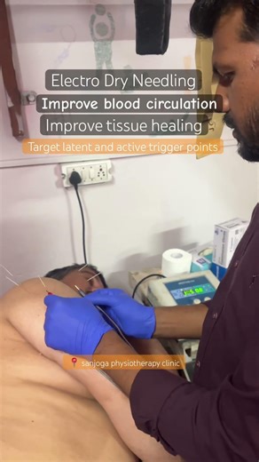 Shoulder pain last two month many trigger points palpate and dry needling applying trigger points .