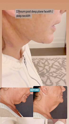 Dr Sam Rizk | Patient is 13 hours post deep plane facelift and deep necklift . With this type of heavy neck it is necessary to not only do a deep plane... | Instagram