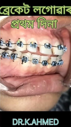 orthodontics treatment before and after.
